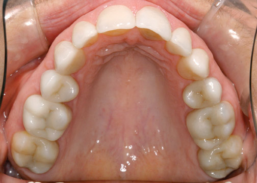 cerec after shot showing nromal looking teeth
